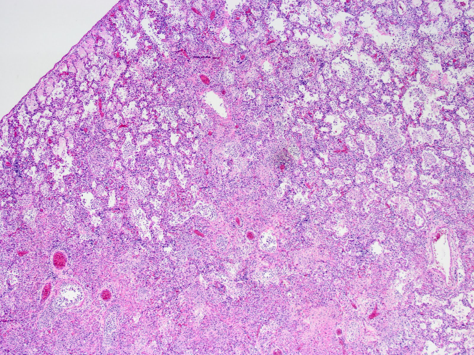 A photomicrograph of a lung showing its alveoli and larger airways to be filled with inflammatory cells & debris.