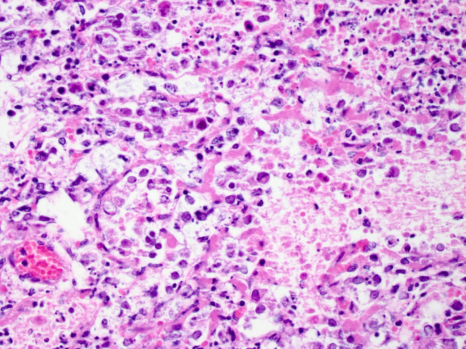 A higher-magnification photomicrograph of a lung showing its alveoli to be filled with inflammatory cells & necrotic cell debris.