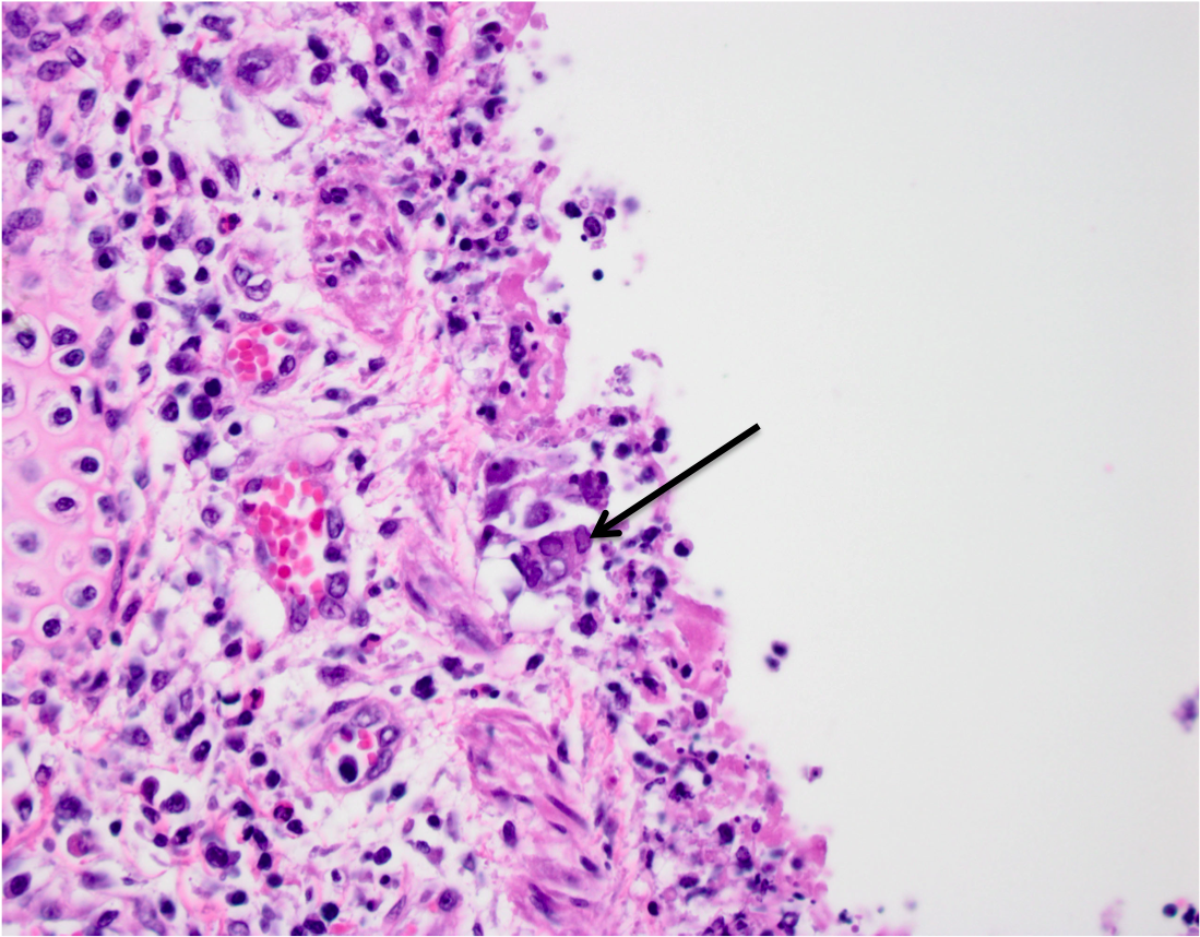 A high-magnification photomicrograph of a lung showing the edge of a bronchus. The epithelium is denuded and there is inflammation and necrotic cell debris in its place. An arrow points to a syncitial cell with nuclei that contain inclusion bodies characteristic of herpesvirus infection.